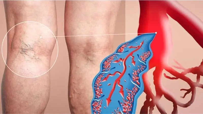 هل تؤدي دوالي الساقين إلى تجلط الدم