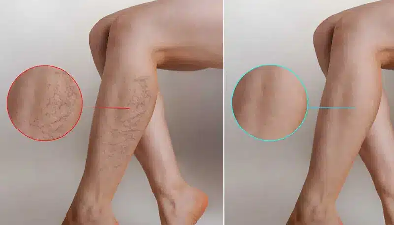 تمنع عودة دوالي الساقين بعد العلاج