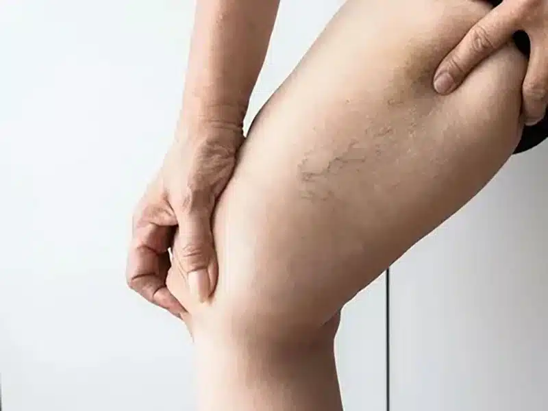 متى تصبح دوالي الساقين خطيرة؟