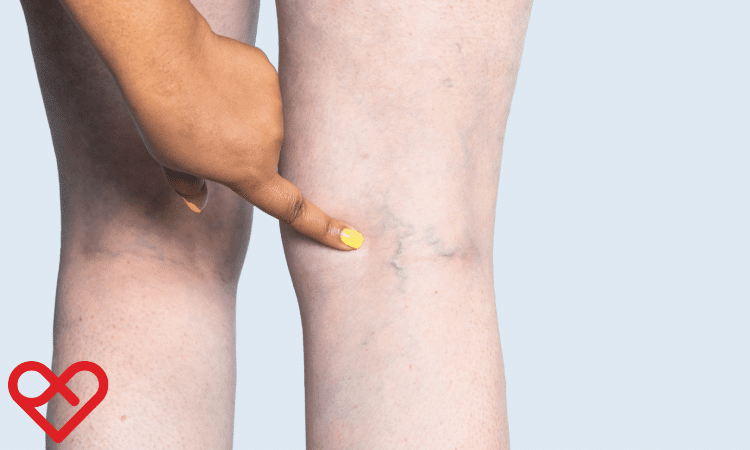 8Common Causes of Varicose Veins in Oman