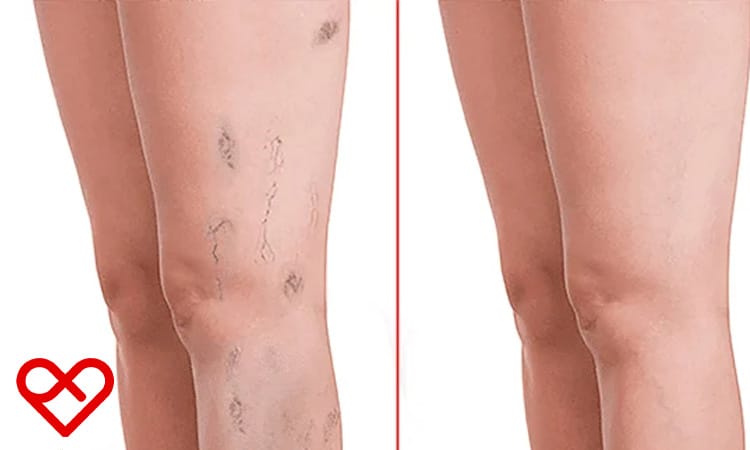 اختيار أفضل مراكز علاج الدوالي في دبي وأبوظبي