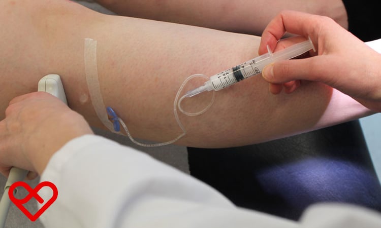 حقن الرغوة (Foam Sclerotherapy)