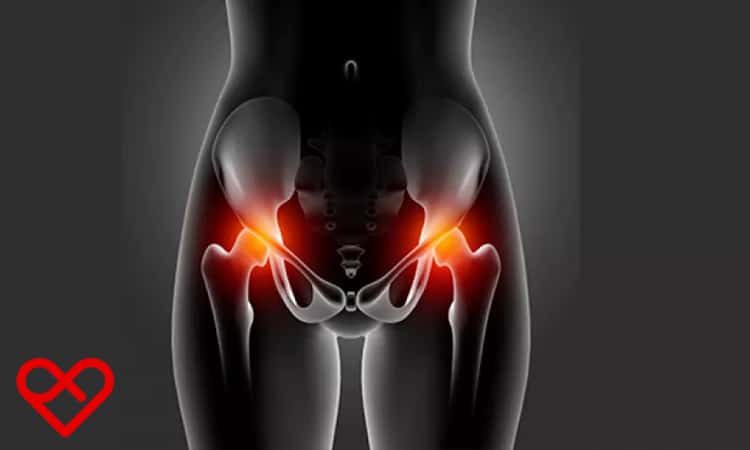 دوالي الحوض (Pelvic Varices)