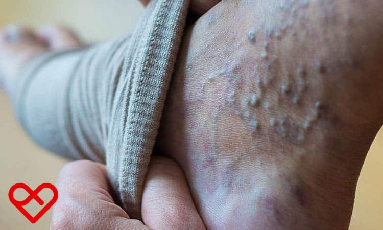 طرق علاج الدوالي