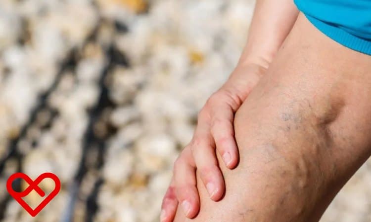 علاج الدوالي بالترددات الحرارية عمان
