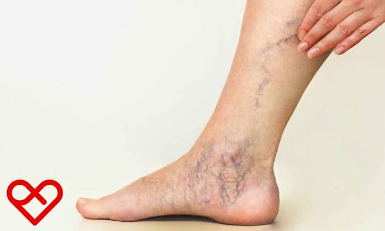 نصائح العناية بعد علاج دوالي الساقين في عمان