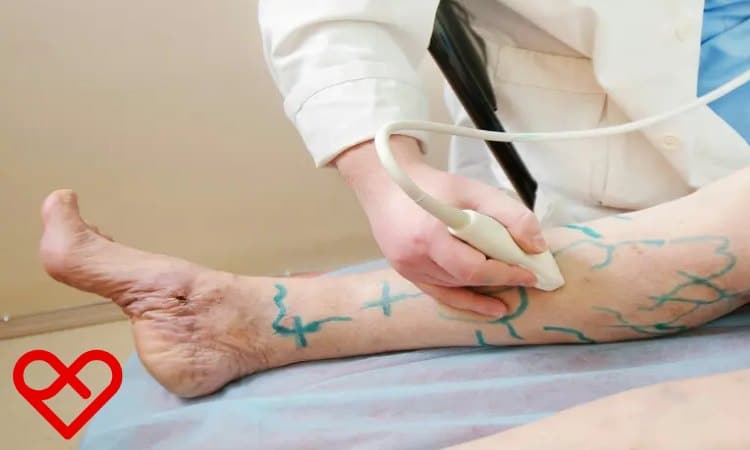 Best Doctor for Varicose Veins in Oman Ensures Healthy